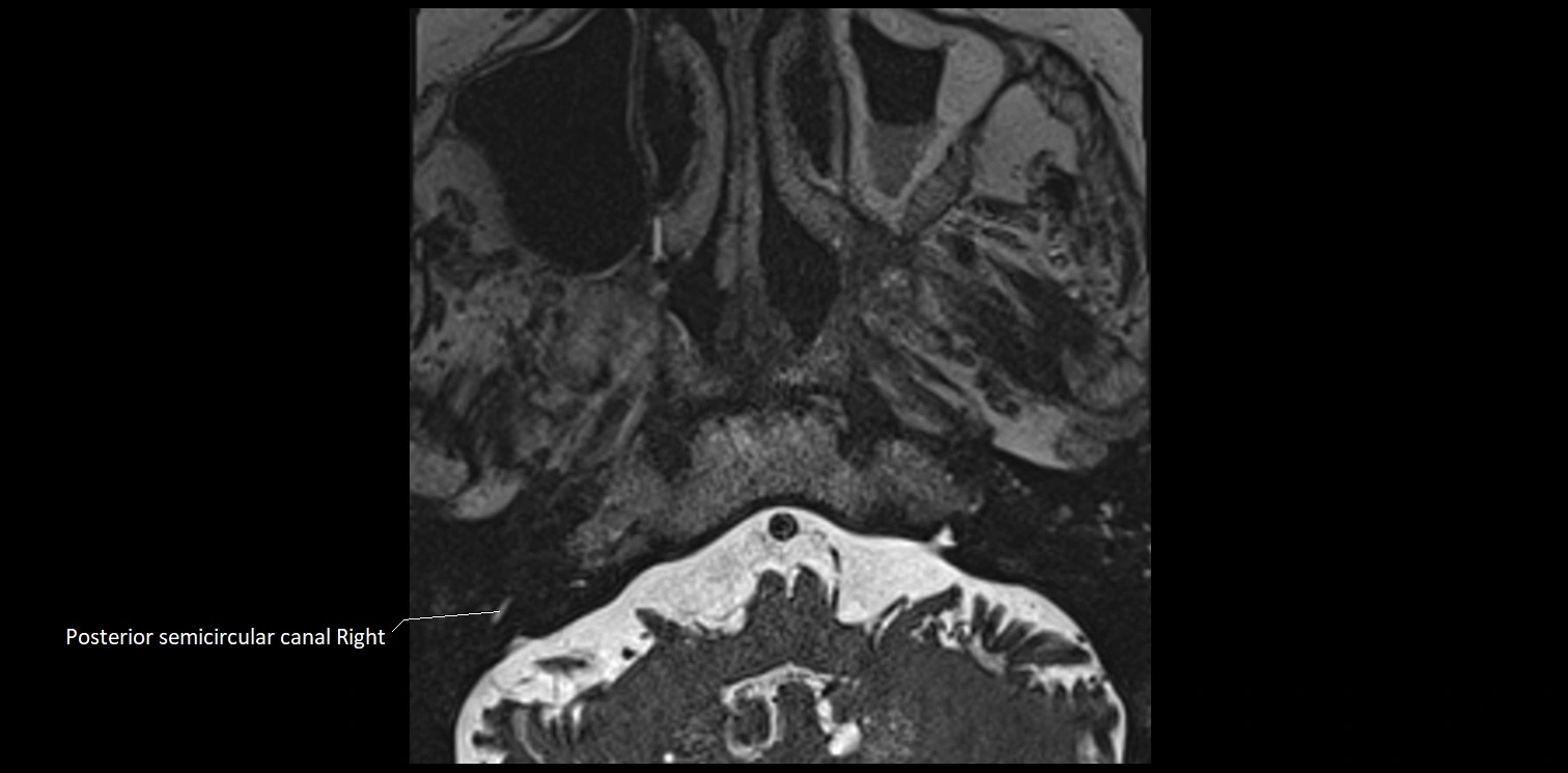 Cranial nerve anatomy axial MRI 3T image 65.webp